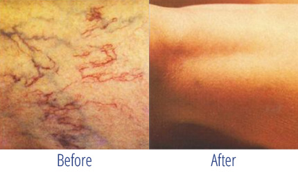 Spider Veins Before and After